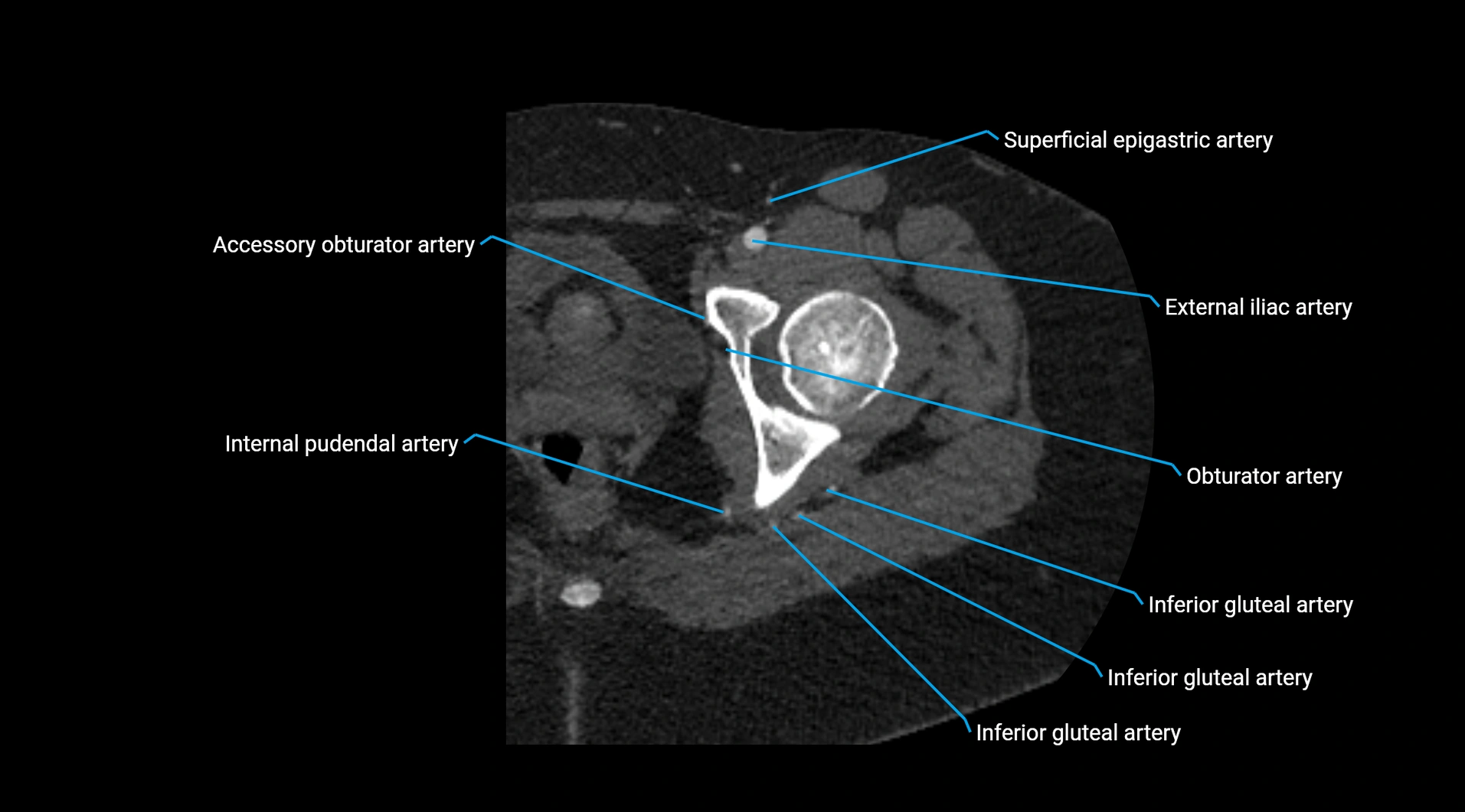 CTA lower limb cross sectional anatomy labelled image _56.webp